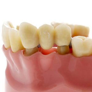 dental bridge