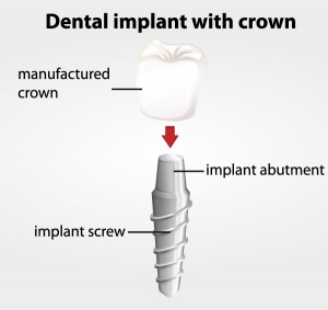dental implants with crown