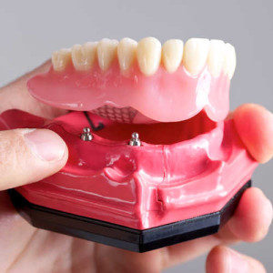 implant dentures