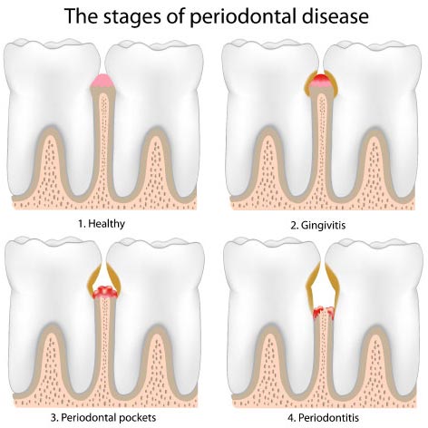 periodontal disease therapy