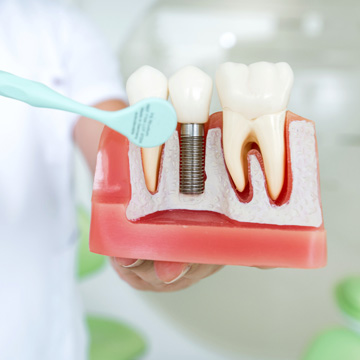what to know before getting dental implants